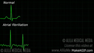 ECG Arrhythmia Detection